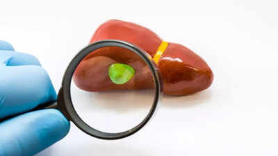 Diet to follow after gallbladder surgery what to eat and avoid for easy digestion and recovery.jpg