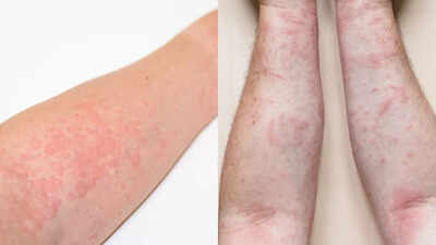 Hives vs rashes spot the signs understand causes and tips to manage effectively.jpg