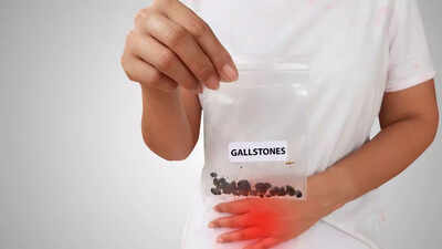 What are gallstones how they may increase the risk of gallbladder cancer.jpg