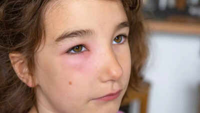 What causes puffy eyes symptoms health conditions and natural remedies.jpg
