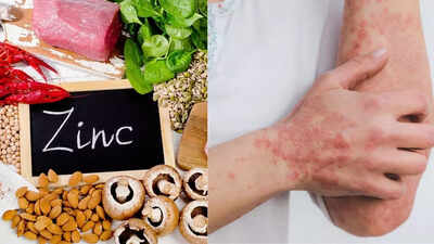 Zinc deficiency symptoms that show up on the skin causes and remedies.jpg