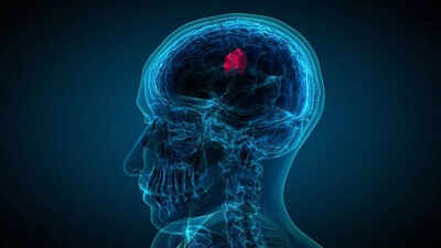 Brain tumour early warning signs that you should not ignore.jpg