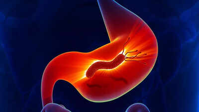 Millions of stomach cancer cases tied to a common bacteria who is at risk early detection and ways to prevent it.jpg