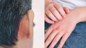Parkinsons disease symptoms on the skin dry skin itching and more.jpg