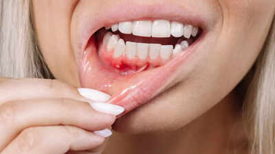 Persistent bleeding gums here are the diseases that could be causing it.jpg