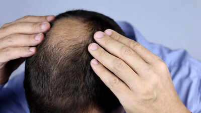 Prevent hair loss with these essential vitamins and minerals.jpg