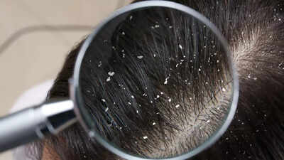 Treat your dandruff right identify your type for flake free scalp.jpg
