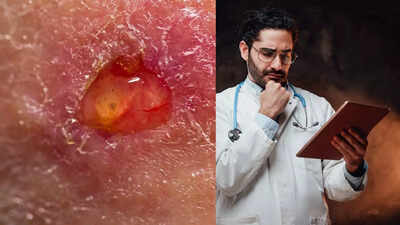 Understanding skin ulcers causes symptoms risk factors and home remedies you must know.jpg