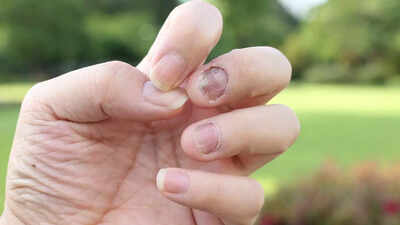 Warning signs in the nails one should not ignore.jpg