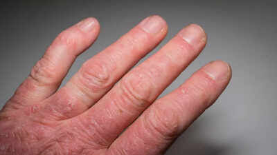 What is psoriatic arthritis know its signs causes and how to manage.jpg