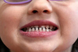 Fda restricts use of kids39 fluoride supplements citing emerging health risks.jpg