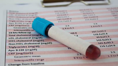 Quotcholesterol is only a part of the equationquot doctor reveals hidden dangers and the plot hole no one notices.jpg