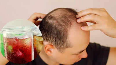 Your favourite soda could be silently causing hair loss and thinning how sugar harms hair follicles.jpg
