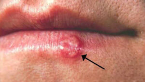 Herpes simplex virus understanding its symptoms outbreak causes how it spreads and tips for managing the infection.jpg