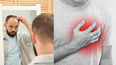 Severe hair loss in men may signal early heart problems what new research reveals.jpg