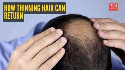 Your hair can come back doctor shares science backed plan to restore thinning hair.jpg