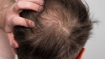 Are hair transplants safe.jpg